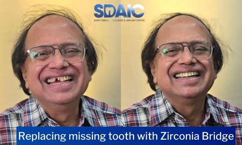 Teeth Crown & Bridge