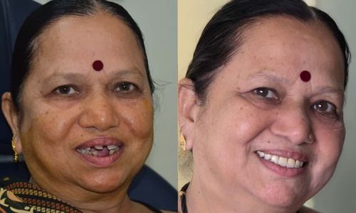 Advanced Implantology