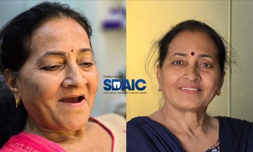 Full Mouth Rehabilitation