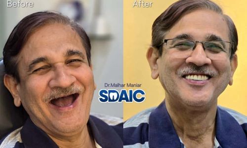 Full Mouth Rehabilitation