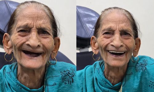 Full Mouth Rehabilitation