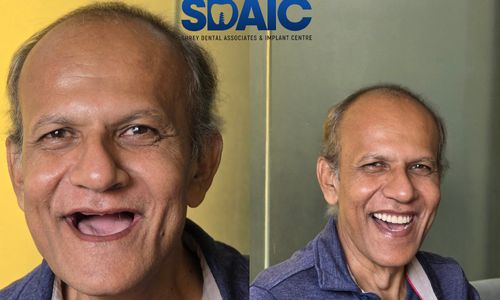 Full Mouth Rehabilitation