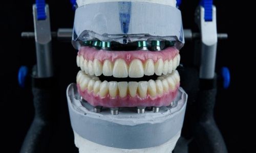 Full Mouth Rehabilitation